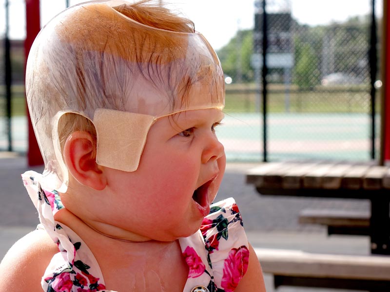 Cranial Helmet Design for Kids